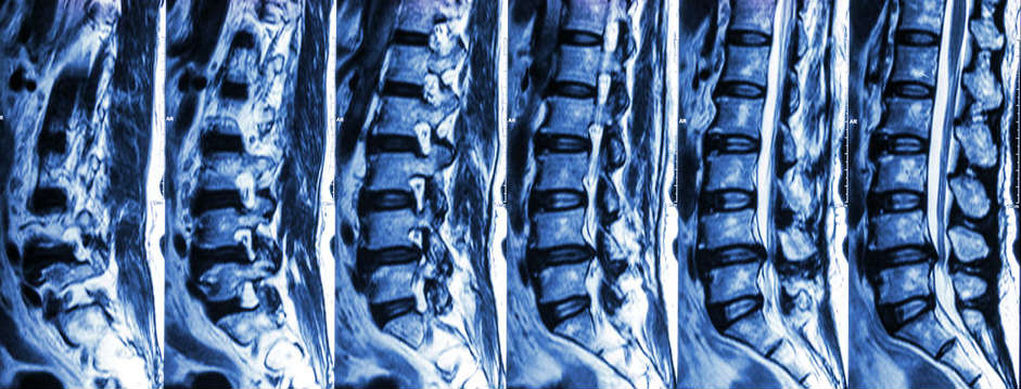 Bulging or herniated disc