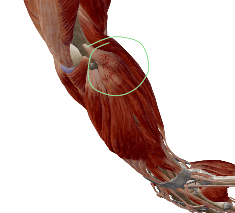 What is Tennis Elbow? — REACH Rehab + Chiropractic, Plymouth MI